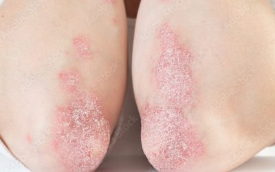 Notícias sobre psoriasis y enfermería 3