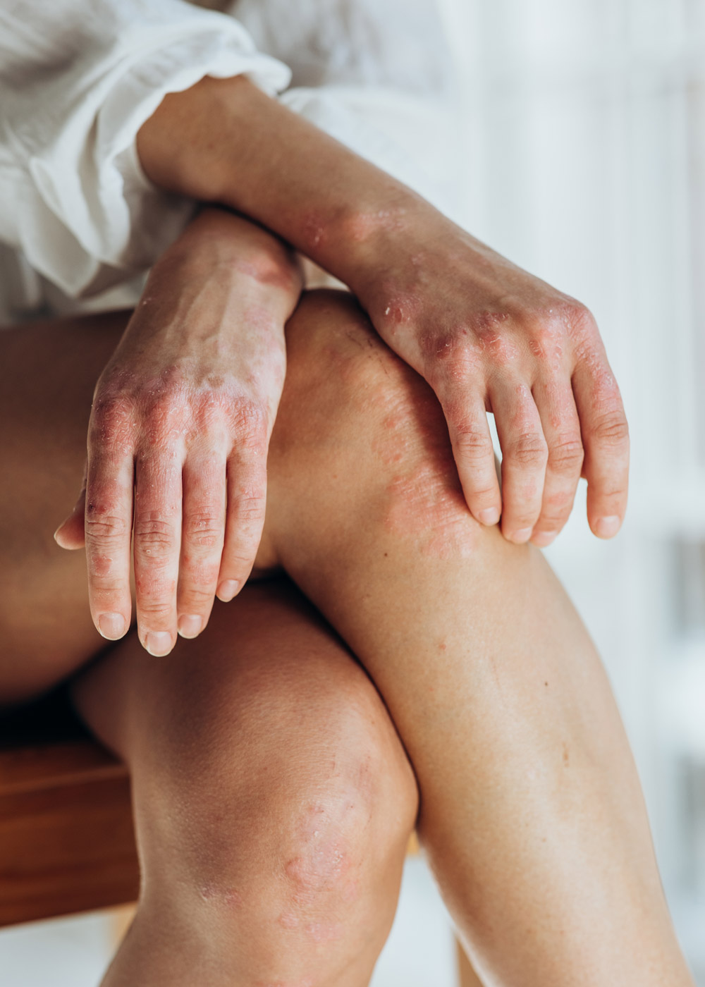 Primer plano de una persona con eczema o psoriasis sentada sobre sus manos y rodillas, mostrando parches de piel inflamados y rojos.